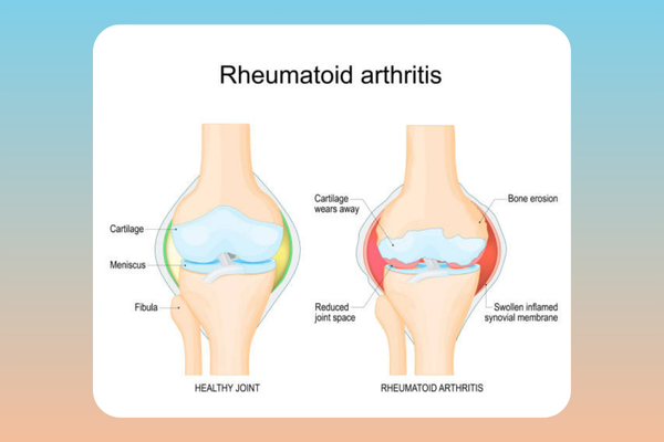 Illustration explaining arthritis, including types like osteoarthritis and rheumatoid arthritis, and common symptoms like joint pain and inflammation